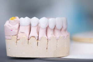 types of dental crowns