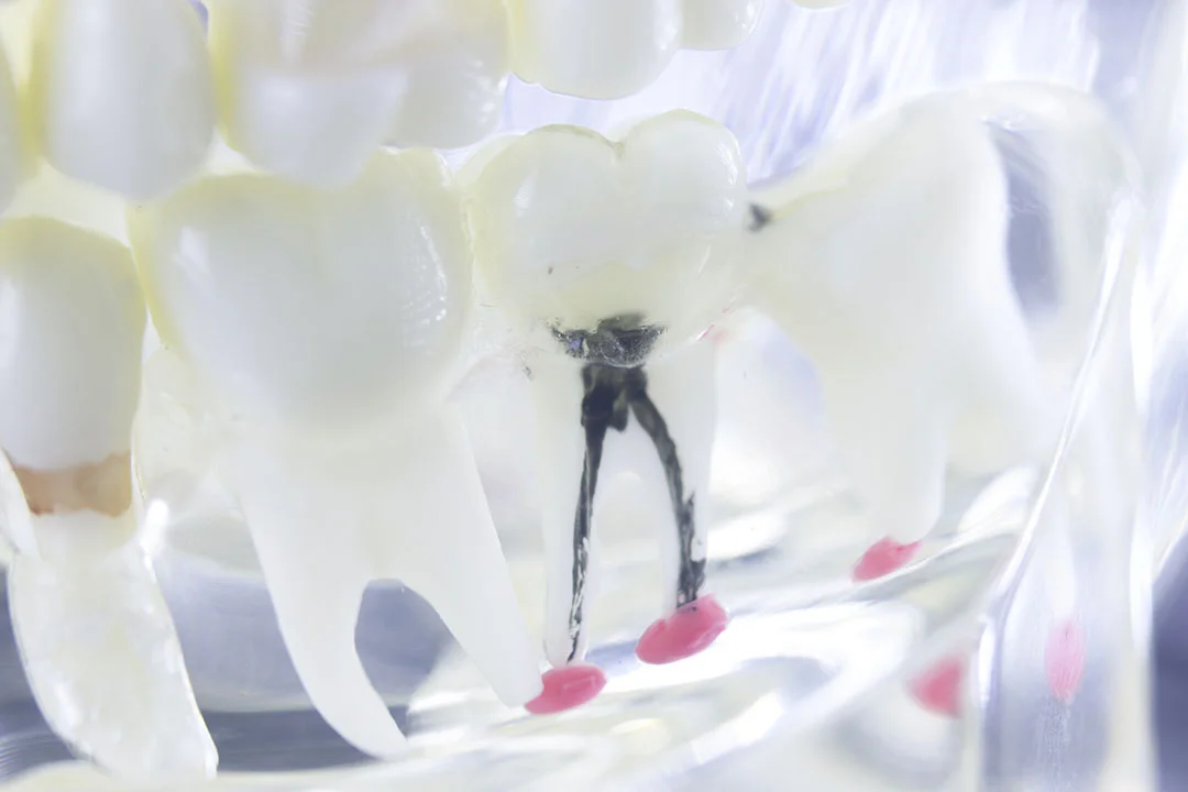 Root Canals - Image