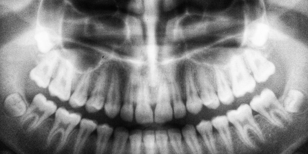 How Much Does Most Dental Insurance Pay for Implants? Exploring Your Coverage - Featured Image