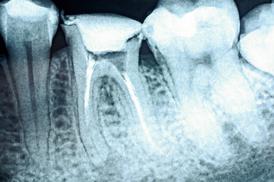does medicare cover root canals