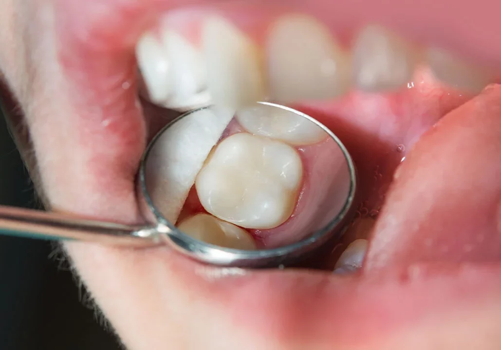 Fillings - Image