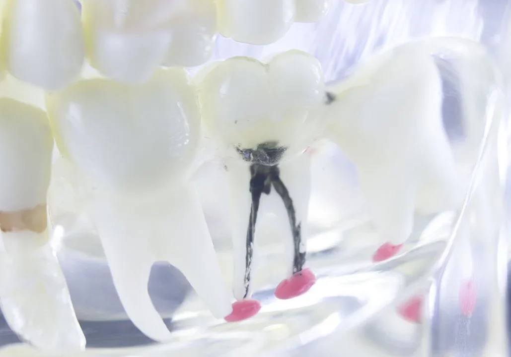 Root Canals - Image
